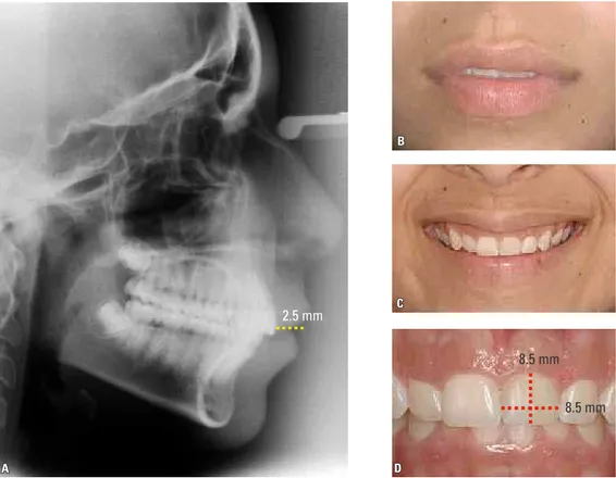 FIGURE 17 - Checklist features evaluated:  A ) Exposure of upper incisors at rest;  B ) interlabial distance at rest and morphological  characteristics of upper lip;  C ) smile arc and functional characteristics of upper lip;  D ) Width/Length ratio of upp