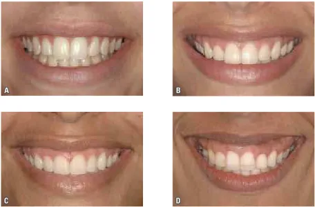 FIGURE 1 - Different degrees of gingival display on smiling:  A ) 0 mm;  B ) 1 mm;  C ) 2 mm and  D ) 4 mm.