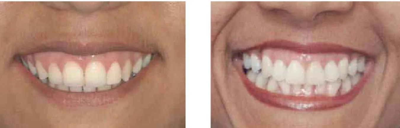 FIGURE 14 - Patients with thin and hyperactive lips are subject to greater gingival display on smiling.