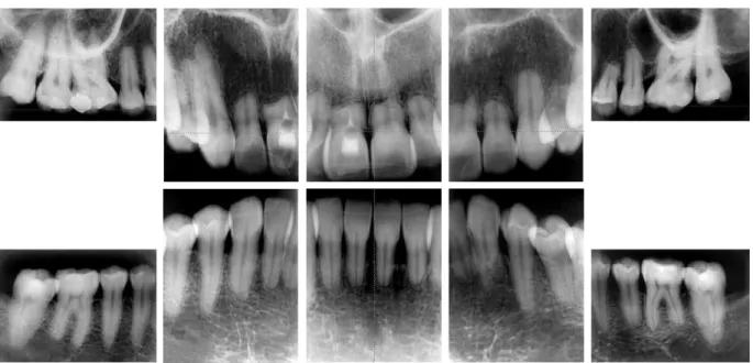 FIGURE 1 - Female patient with anterior open bite underwent orthodontic treatment for 8 years with continuous use of intermaxillary elastic bands