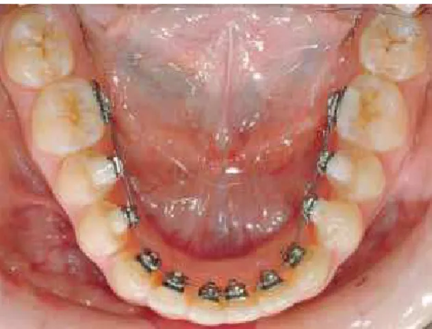 FIGURE 1 - Straight Wire lingual appliance.