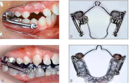 FIGURE 1 - A) Side view of CBJ, B) occlusal view of CBJ; C) side view of Herbst appliance (LRAS), D) occlusal view of Herbst appliance (LRAS).