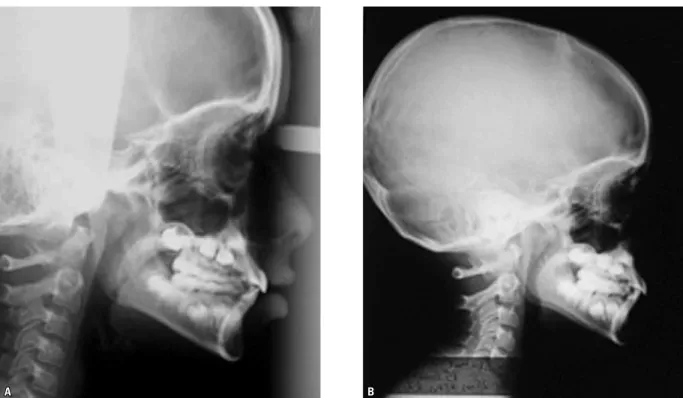 FIGURE 1 - Lateral cephalometric radiograph ( A ) and cavum radiograph ( B ) obtained from the same mouth breathing patient, in the same day.