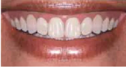 FIGURE  3  -  Flat  gingival  margin:  Central  inci- inci-sors reduced by 2 mm and laterals increased  by 0.5 mm.