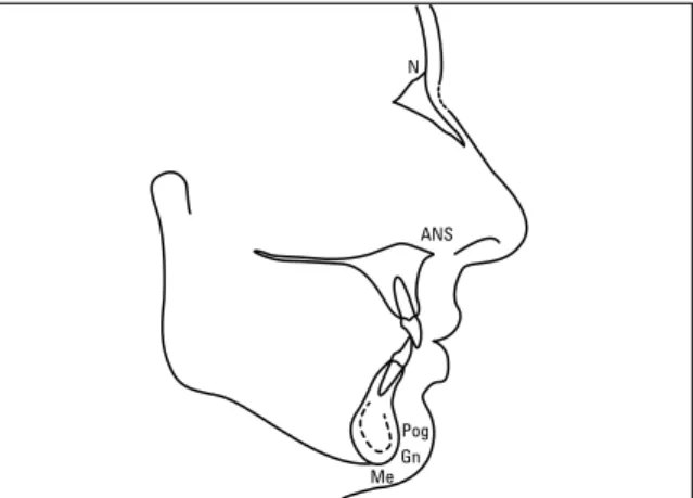FIGURE 1 - Cephalogram showing anatomical structures and cephalomet- cephalomet-ric landmarks used for evaluating facial proportions in vertical direction.