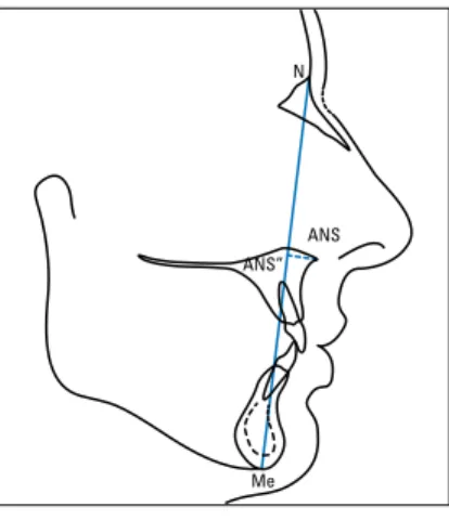 FIGURE 3 - Cephalogram showing evaluation of  facial proportions in vertical direction,  accord-ing to Wylie and Johnson’s analysis.