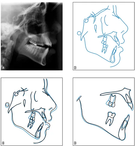 FIGURE 10 - Lateral cephalogram (A) and cephalometric tracing (B). Total (C) and partial (D) super- super-impositions of initial (black) and intermediate (blue) cephalometric tracings