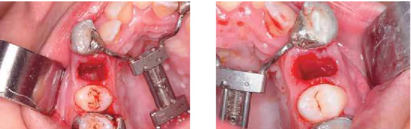 FIGURE 22 - Occlusal photographs of deepening and corticotomies used in surgical technique.