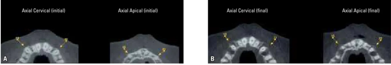 FIGURE 24 - Standardized axial sections of cervical and apical canine regions before ( A ) and after ( B ) RCR showing canine movement into alveolar process.