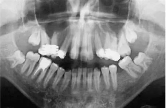 FIGURE 6 - Transoperative x-ray showing deepening of the tooth socket  above canine apex.
