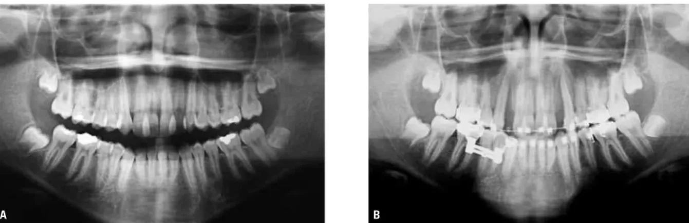 FIGURE 8 - Initial ( A ) and post-RCR ( B ) panoramic x-rays in upper arch showing change in axial inclination of canines.