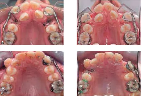 FIGURE 11 - Occlusal photos of movement of maxillary canines in two different cases, showing procli- procli-nation