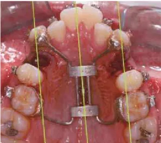FIGURE 13 - Occlusal photograph of palatal distractor. Black lines indi- indi-cate canine movement path.
