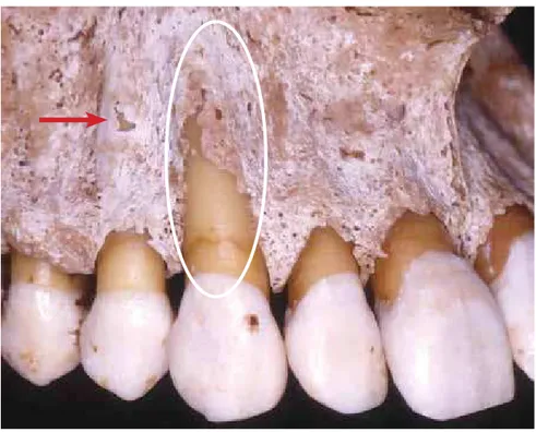 Figure 1 - Buccal cortical bone of maxillary canine with dehiscence, also showing a small fenestration in  the first premolar (arrow).Note the sensitivity of buccal alveolar cortical bone thickness.