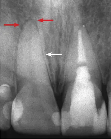 Figure 3 - Occlusal trauma with thickening of the lamina dura (white ar- ar-row) and widening of the periodontal space with increased diffuse  peri-odontal bone density (red arrows), and vertical bone loss (green arrow).
