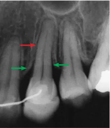 Figure 5 - Note occlusal trauma with considerable increase in periapical  bone density (circle) and in the bone crest (green arrow).