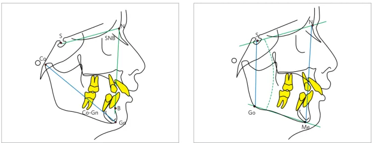 Figure 1 - Analysis of sagittal development was based on the following  measures: SNB, Co-Gn