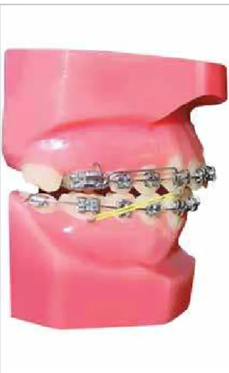 Figure 1 - Upper and lower arches prepared to re- re-ceive the T10.