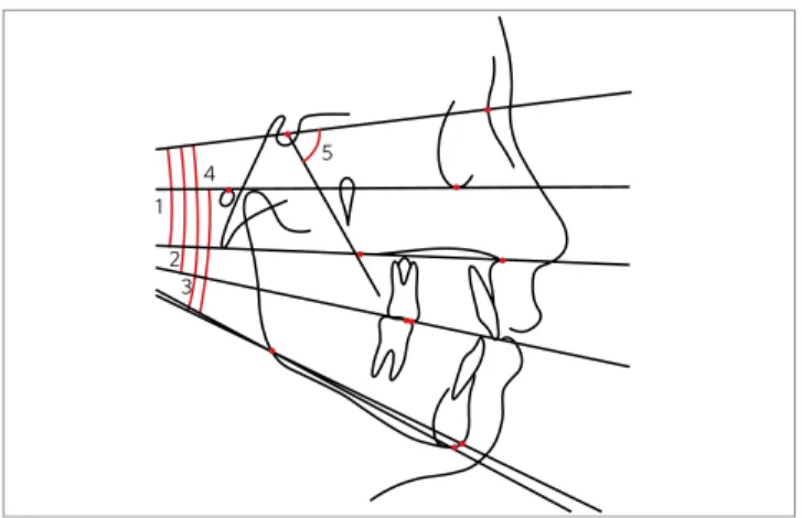 Figure 1 - Cephalometric tracing with the angular variables analyzed  in  the growth pattern