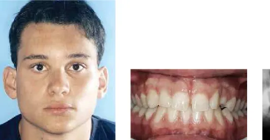 Figure 2 - Patient with peg-shaped maxillary lateral incisor.