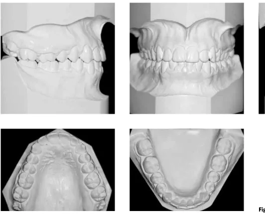 Figure 9 - Final panoramic radiograph. Figure 10 - Final periapical radiographs.