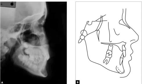 Figure 3 - Initial profile cephalometric radiograph (A) and cephalometric tracing (B).