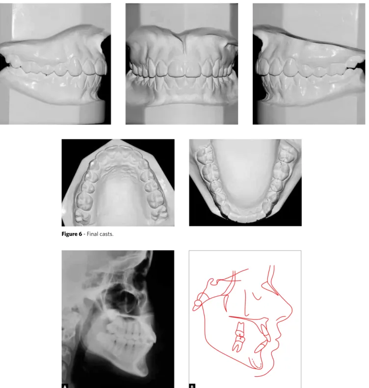 Figure 6 - Final casts.