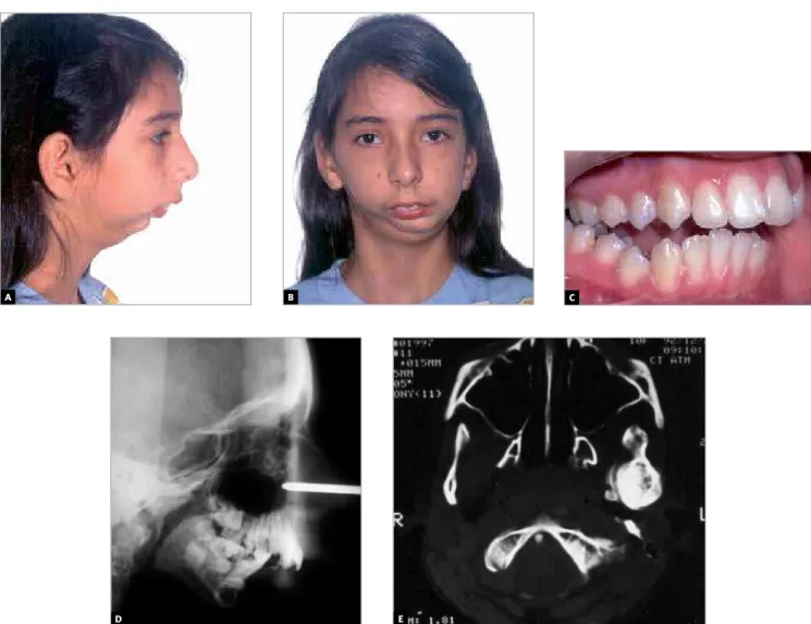 Figure 11 - After two interventions and 4 years into treatment, there was improvement in oral movements and esthetics (A, B)