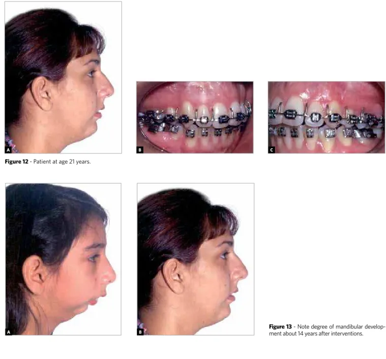 Figure 13 - Note degree of mandibular develop- develop-ment about 14 years after interventions.
