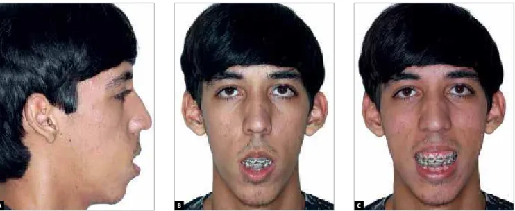 Figure 16 - 14 months postoperatively. Note improvement in interlabial relationship. Changes in behavior and attitude were remarkable.