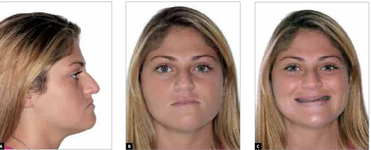 Figure 19 - Patient about 8 months after surgery.