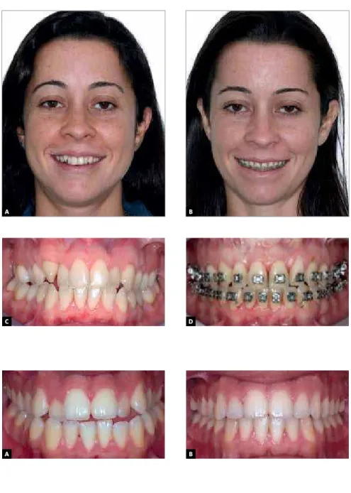 Figure 3 - Class III malocclusion and maxil- maxil-lary constriction before ortho-surgical  treat-ment