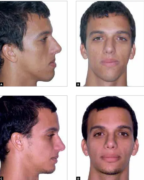 Figure 5 - A,  B) This patient is a good candi- candi-date for maxillary advancement combined  with maxillary repositioning