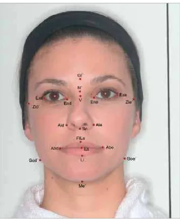 Figure 1 - Photometric Points: Gl’ – soft tissue glabella; N’ - soft tissue  nasion; Exd-right external corner of the eye; Exe – left external corner of  the eye; End – right internal corner of the eye; Ene – left internal corner  of the eye; V – Point V; 