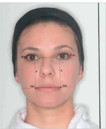 Figure 2 - Linear measurements from 1 to 9: 1) Upper lip length (Sn–Es); 