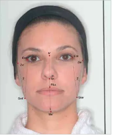 Figure 7 - Angular measures 3 and 4: 3) V Angle - angle formed by lines ex- ex-tending from V to God’ point and from V to Goe’; 4) Facial aperture  modi-fied angle - angle formed by right and left lines extending from Exd to Exe  to Me’ point