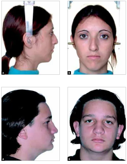 Figure  8 - A) Frontal facial photograph of a  Long Facial Pattern patient with cleft palate