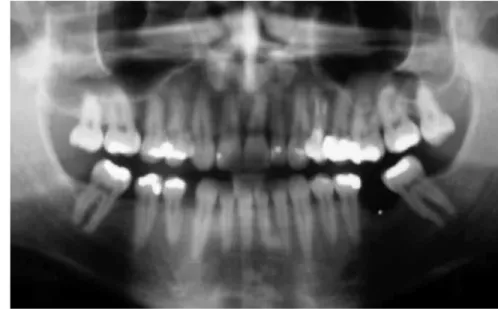 Figure 3 - Lateral cephalogram. Figure 4 - Panoramic radiograph. Observe the absence of teeth #12, 16, 36, 38, 46 and 48.