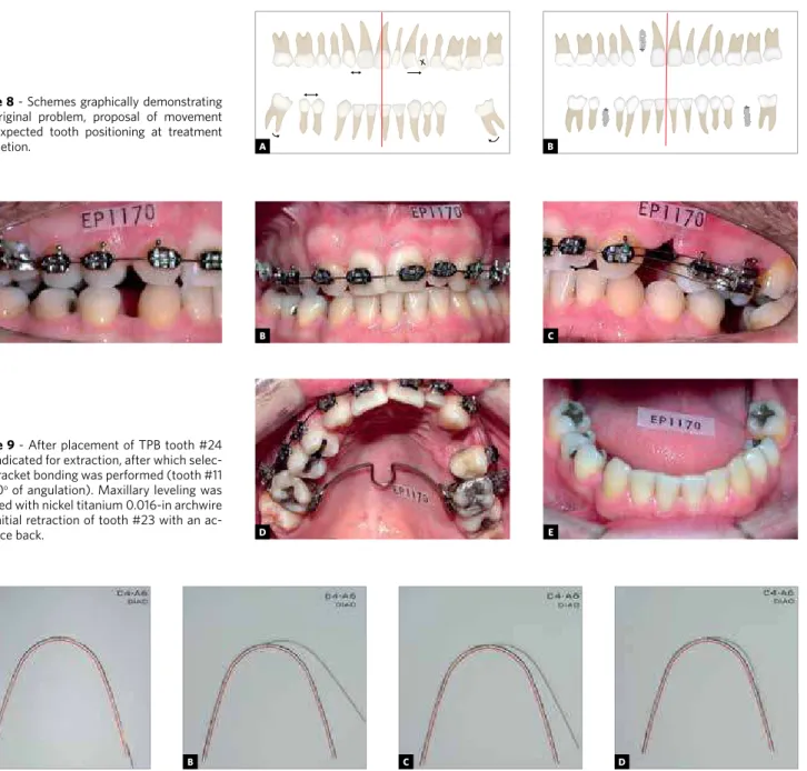 Figure 9 - After placement of TPB tooth #24  was indicated for extraction, after which  selec-tive bracket bonding was performed (tooth #11  with 0 o  of angulation)