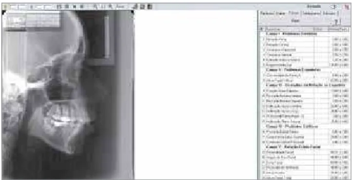 Figure 2 - Lateral cephalometric radiograph being analyzed in Radiocef  Studio 2 software (configuration: Ricketts cephalometric analysis).