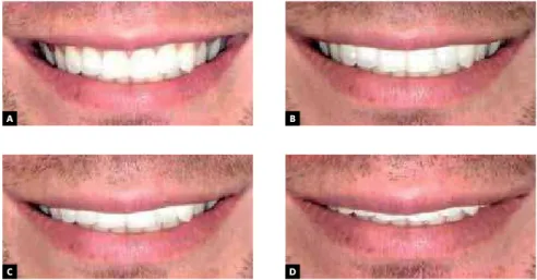 Figure 1 - Masculine spontaneous smile in gin- gin-gival margin level of: 0 mm (A), reduction of  ex-posure in 2 mm (B),- 4 mm (C) and - 6 mm (D).