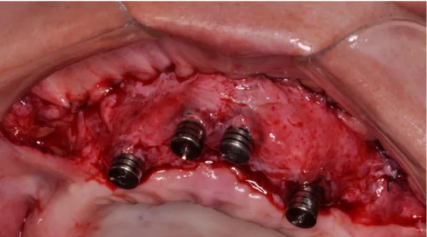 Fig 18: Matriz de colágeno porcino (Geistlich Mucograft®)	
  