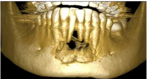 Figura 4: Reconstrução 3D de mandíbula, mostrando perda parcial da cortical  anterior vestibular