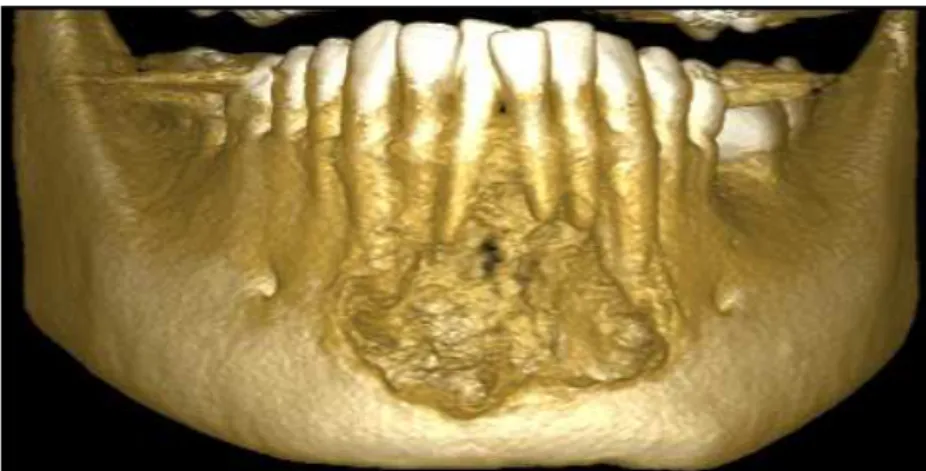 Figura 7: Reconstrução 3D de mandíbula após 4 meses de tratamento. Observa- Observa-se áreas de neoformação ósObserva-sea em cortical ósObserva-sea vestibular
