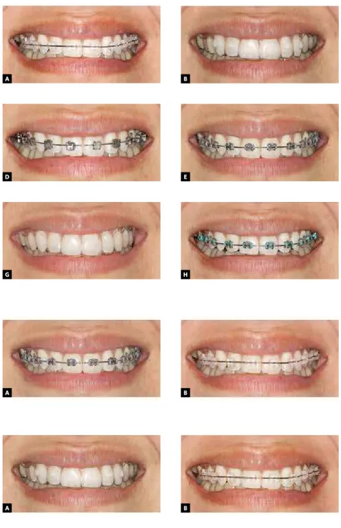 Figure 3 - Images captured for the first WTP  evaluation (second sheet): A) Traditional  me-tallic brackets; B) sapphire esthetic brackets  with metal archwire.