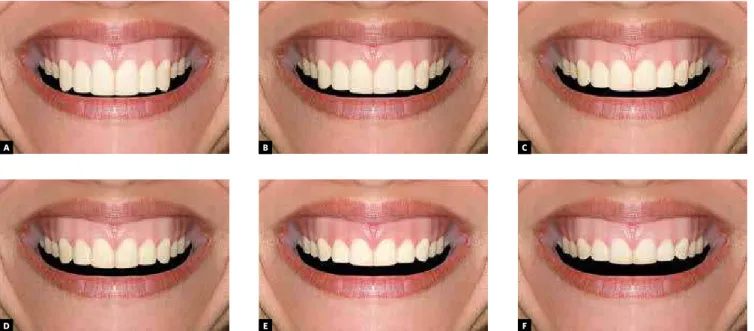 Figure 2 - Example of figures diagramming, for one of the used smiles, with the six width/height proportions assessed, without displaying inferior teeth  (black mask): A) 65%; B)70%; C)75%; D)80%; E)85% and F)90%.