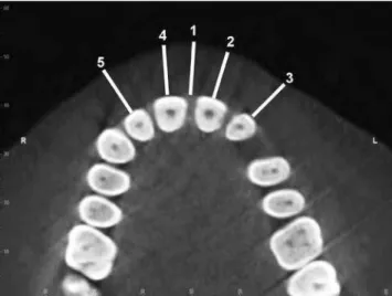 Figure 5 - Measurements of the lower lip thickness: 6) right central inci- inci-sor, 7) right lateral inciinci-sor, 8) left central inciinci-sor, 9) left lateral incisor.