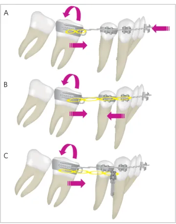 Figure 11 - Biomechanics of running loop archwire in lateral view. Uprighting  and mesial movement of molars in the case of no crowding (A) and  crowd-ing (B) in the anterior teeth, and uscrowd-ing mini-implant anchorage (C).