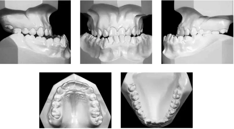 Figure 2 - Initial dental casts.