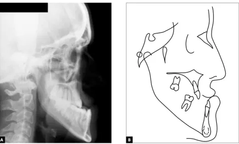 Figure 4 - Initial lateral cephalometric radiograph (A) and cephalometric tracing (B).